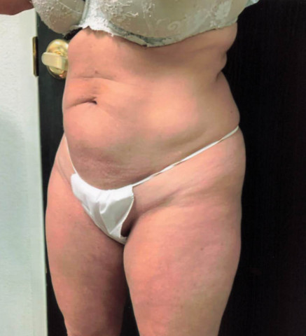 Tummy Tuck before and after - before