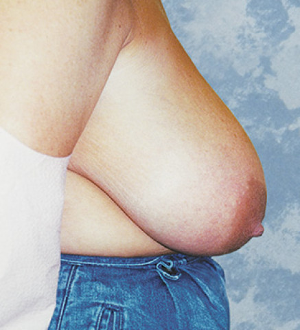 Breast Lift before and after - before