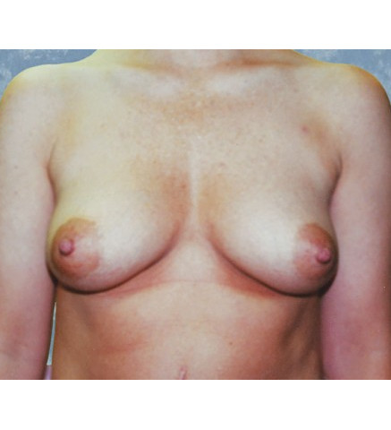 Breast Augmentation before and after - before