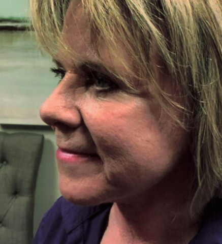 Facelift before and after - before