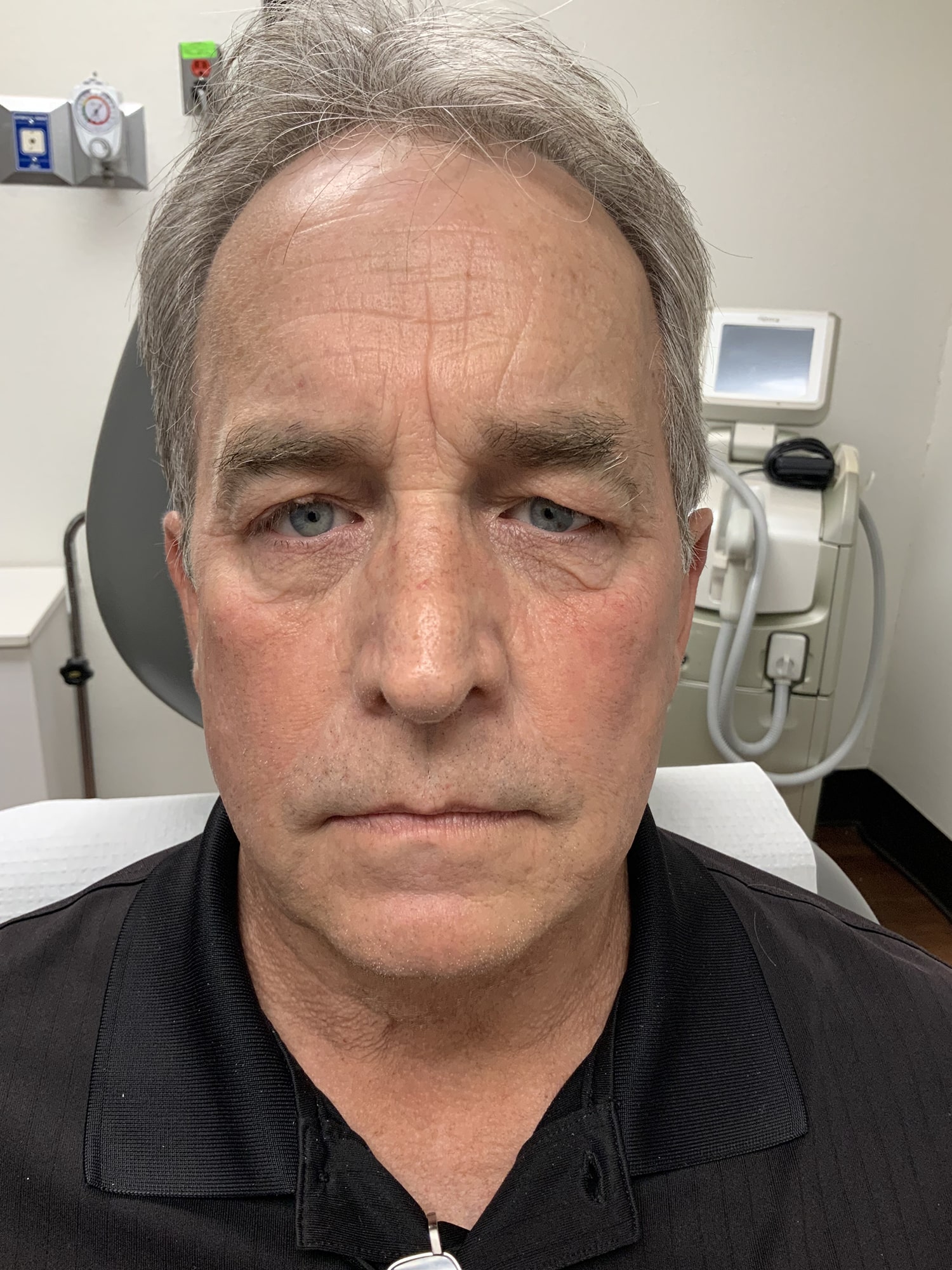Procedure before and after - before