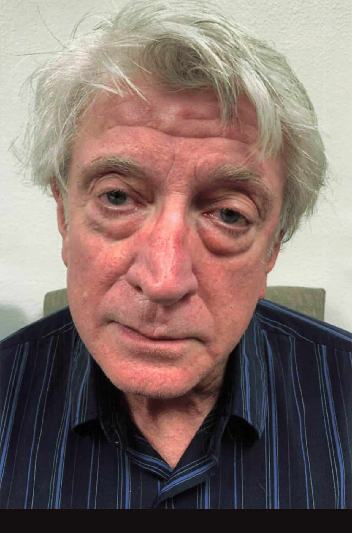 Lower Blepharoplasty before and after - before