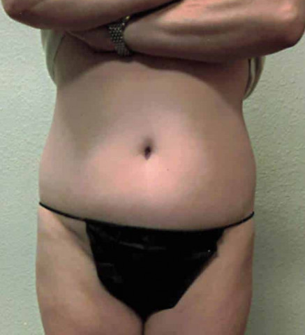 Tummy Tuck before and after - before