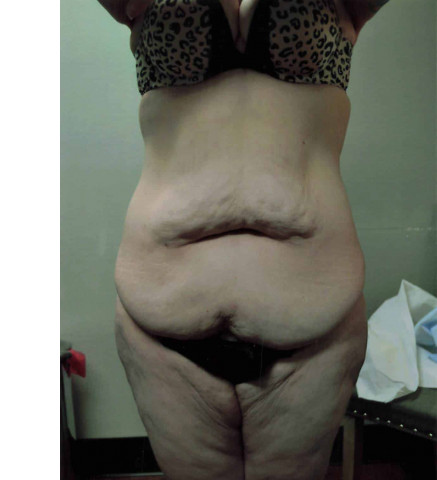 Mommy Makeover before and after - before
