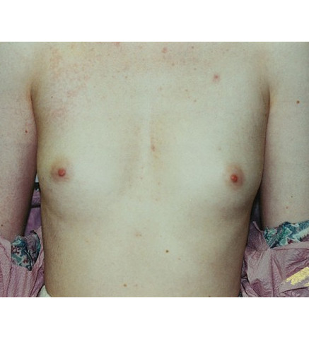 Breast Augmentation before and after - before