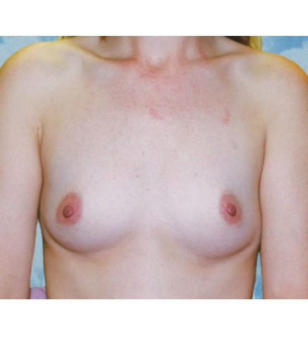Breast Augmentation before and after - before