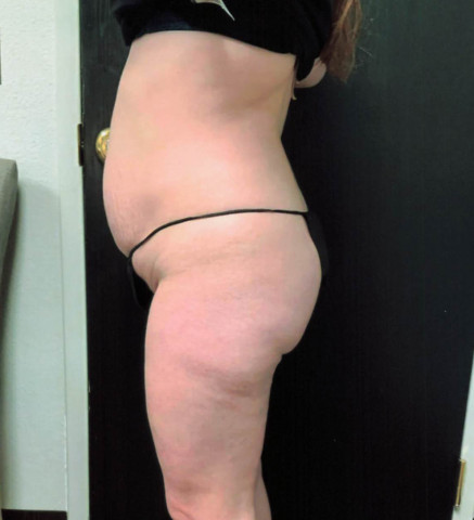 Liposuction before and after - before