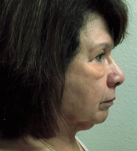 Facelift before and after - before