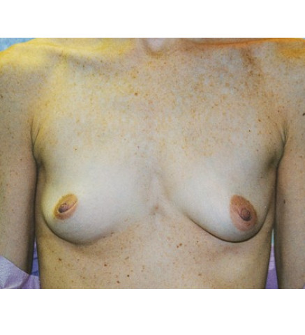 Breast Augmentation before and after - before