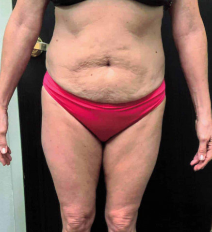Tummy Tuck before and after - before