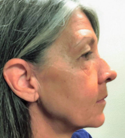 Facelift before and after - before
