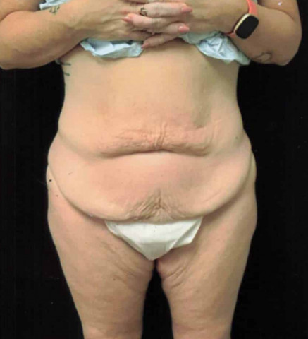 Tummy Tuck before and after - before
