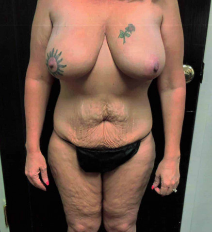Mommy Makeover before and after - before