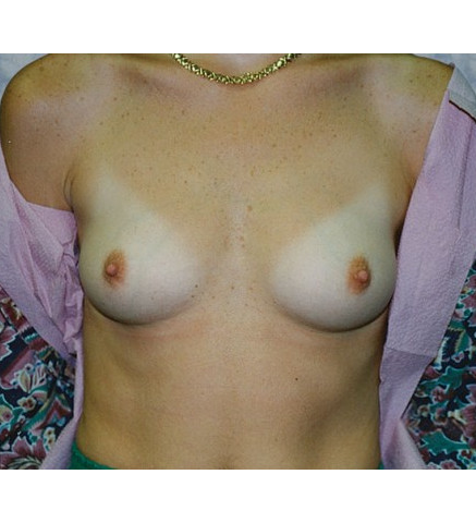 Breast Augmentation before and after - before