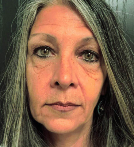 Facelift before and after - before