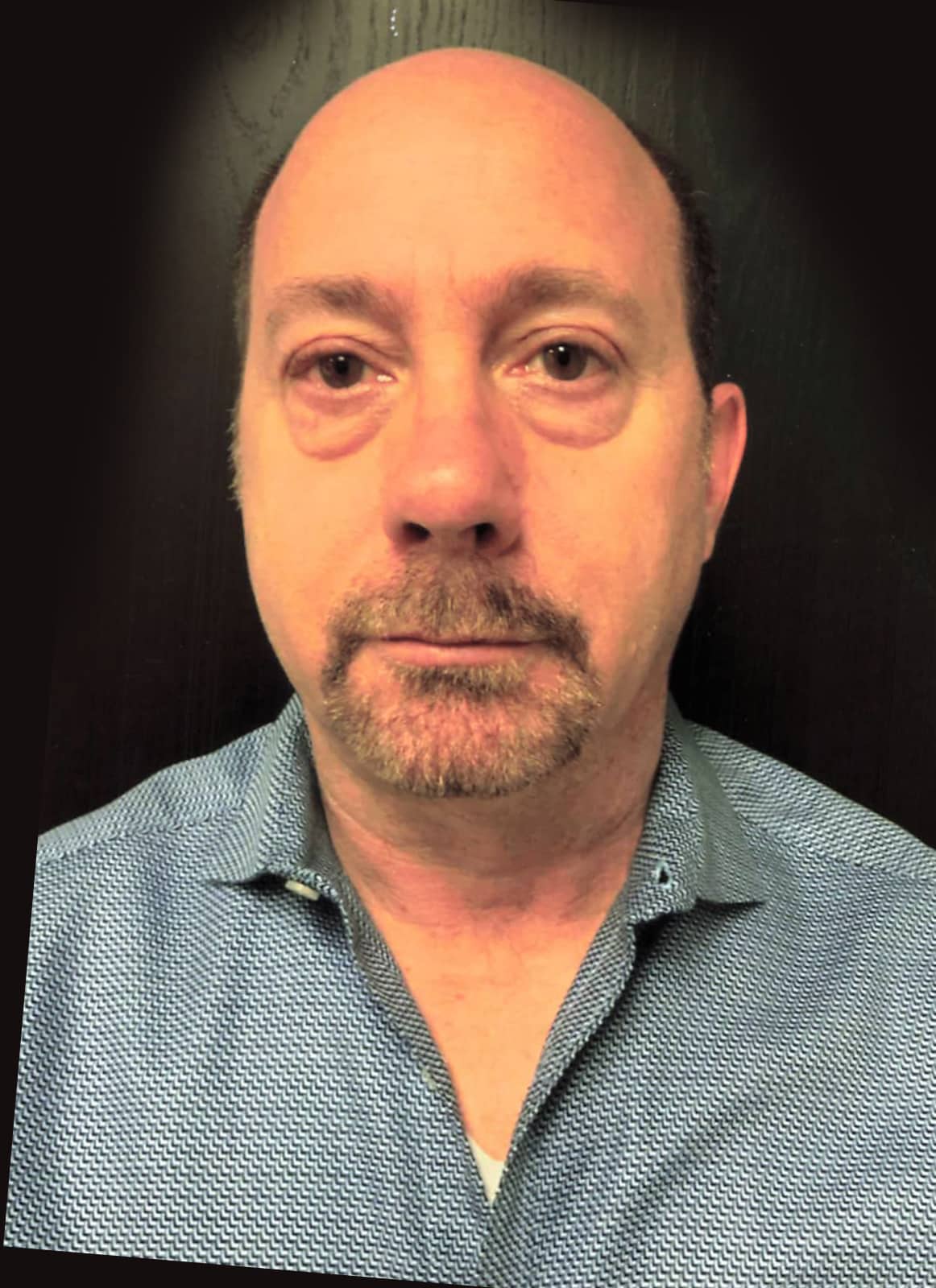 Lower Blepharoplasty before and after - before