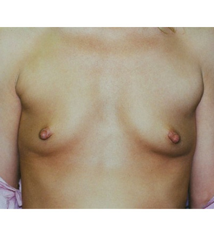 Breast Augmentation before and after - before