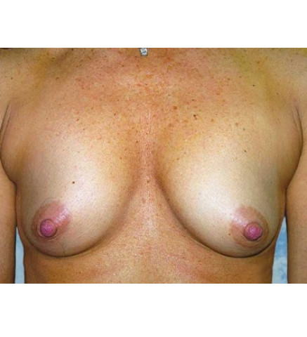 Breast Augmentation before and after - before