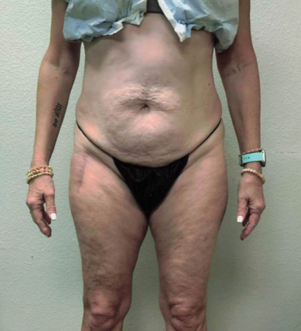 Liposuction before and after - before