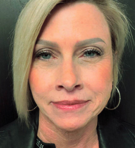 Facelift before and after - before
