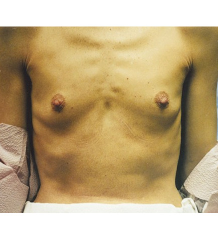 Breast Augmentation before and after - before