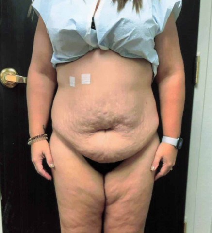 Tummy Tuck before and after - before