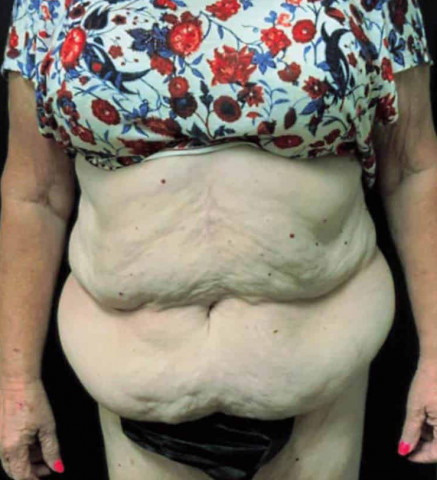Tummy Tuck before and after - before
