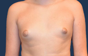 Gynecomastia (Male Breast Reduction) before and after - before