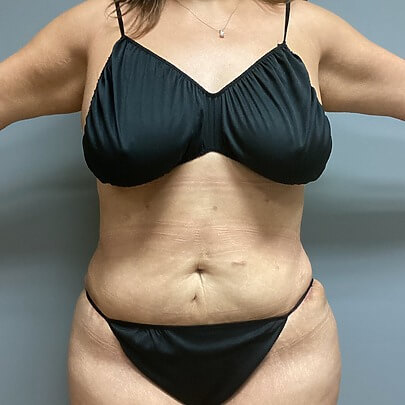 Tummy Tuck before and after - after