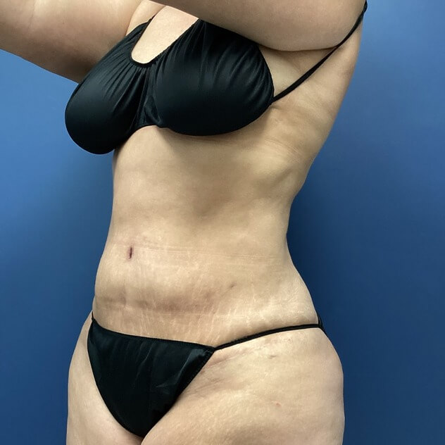 AbEX before and after - after