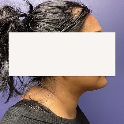 Chin before and after - after