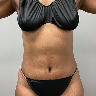 Mommy Makeover before and after - after