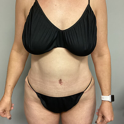 Tummy Tuck before and after - after
