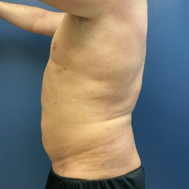 Liposuction before and after - after