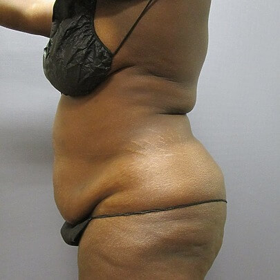 Tummy Tuck before and after - before