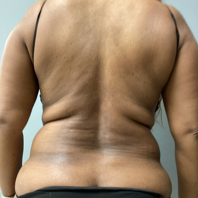 Liposuction before and after - before