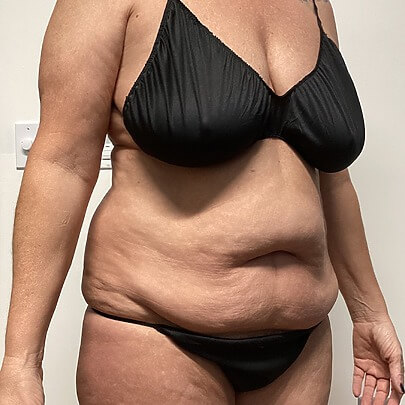Mommy Makeover before and after - before