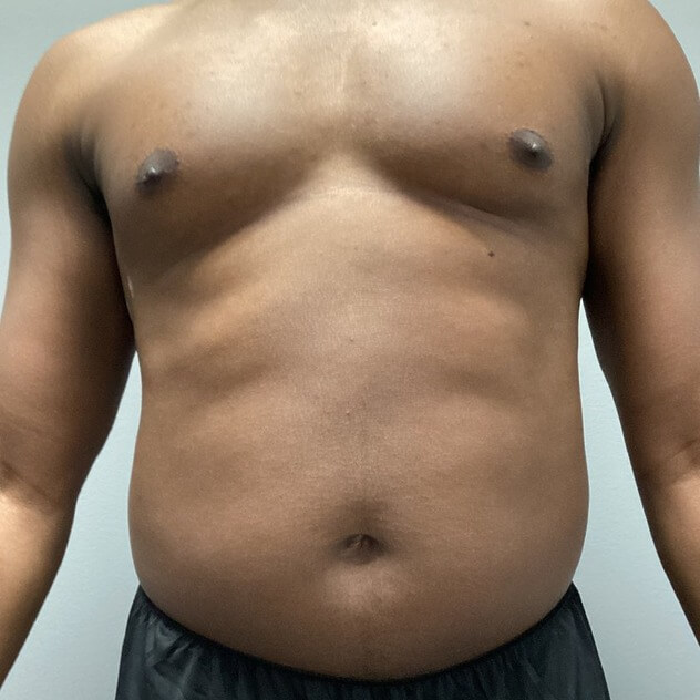 Liposuction before and after - before