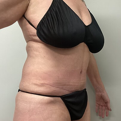 Mommy Makeover before and after - before