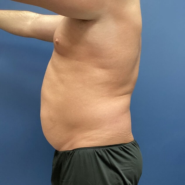 Liposuction before and after - before