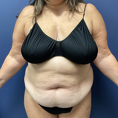 Tummy Tuck before and after - before