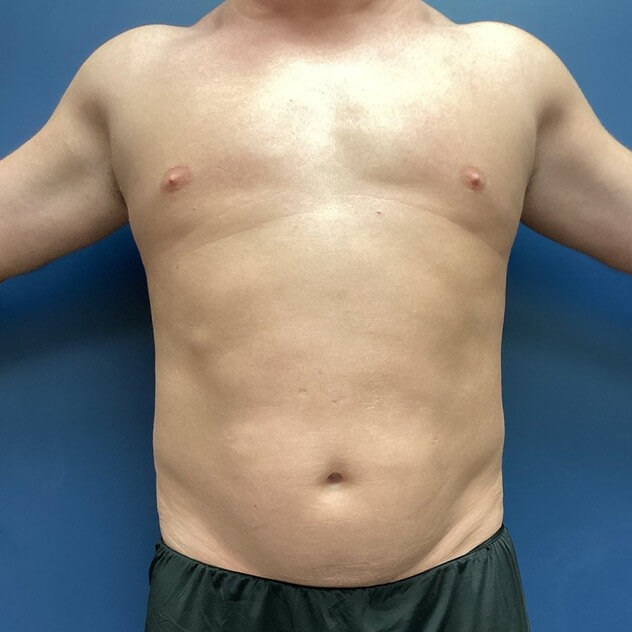 Liposuction before and after - before