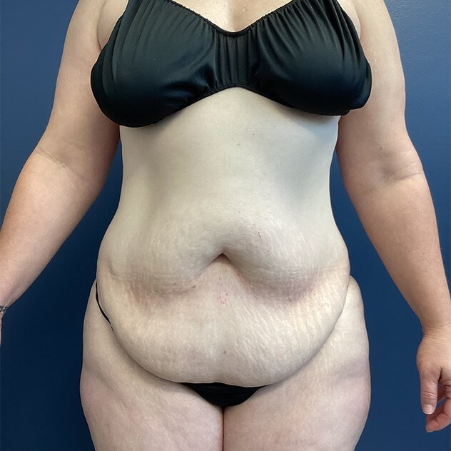 AbEX before and after - before