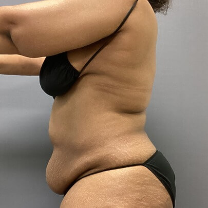 Tummy Tuck before and after - before