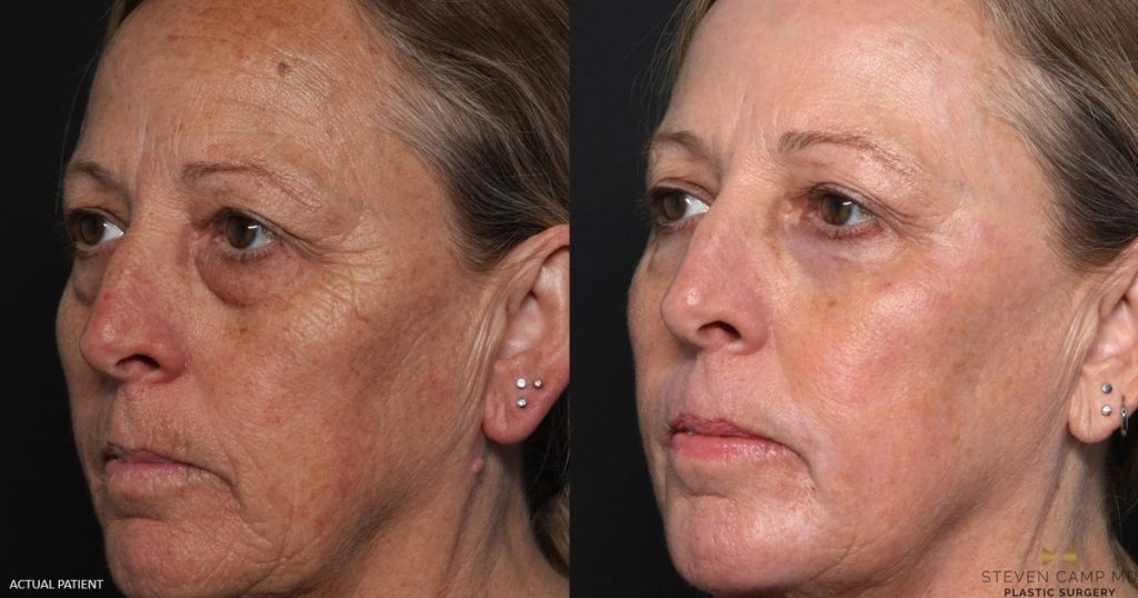 Blepharoplasty before and after - after