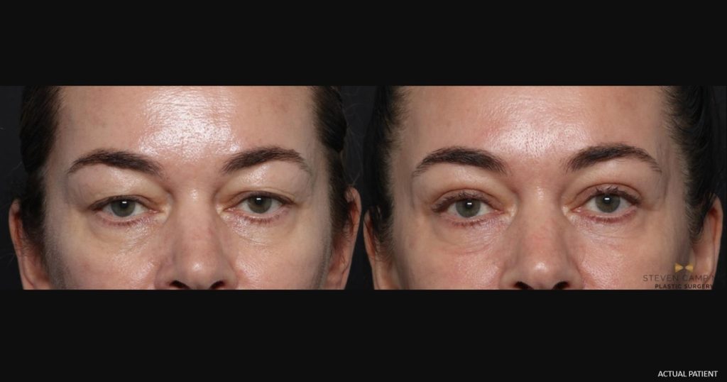 Blepharoplasty before and after - before