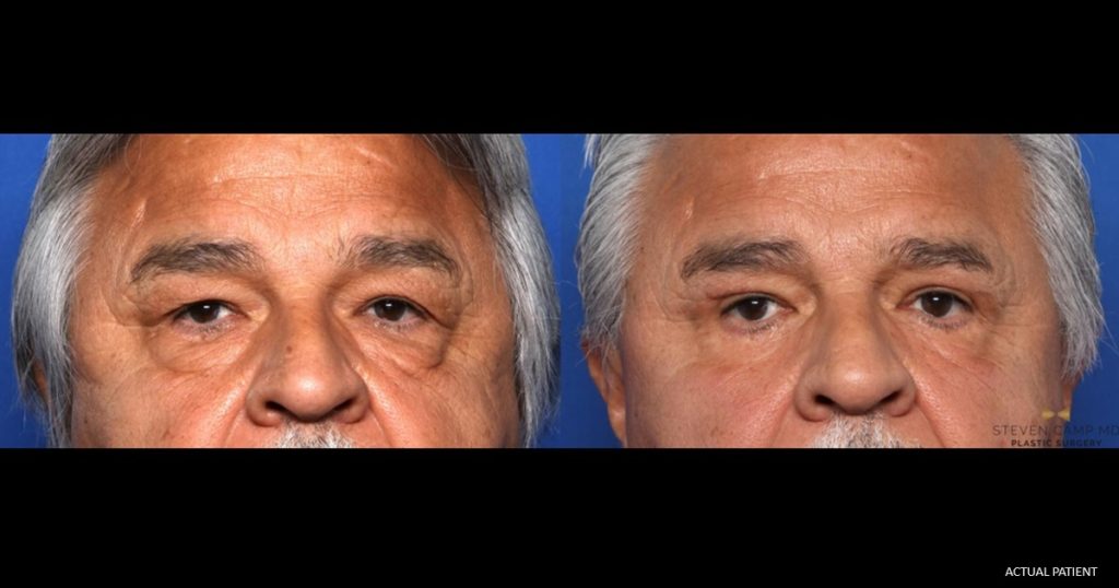 Blepharoplasty before and after - before
