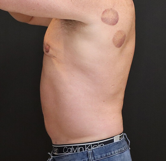 Liposuction before and after - after