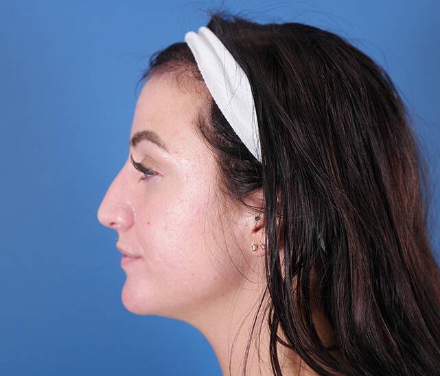 Rhinoplasty before and after - after
