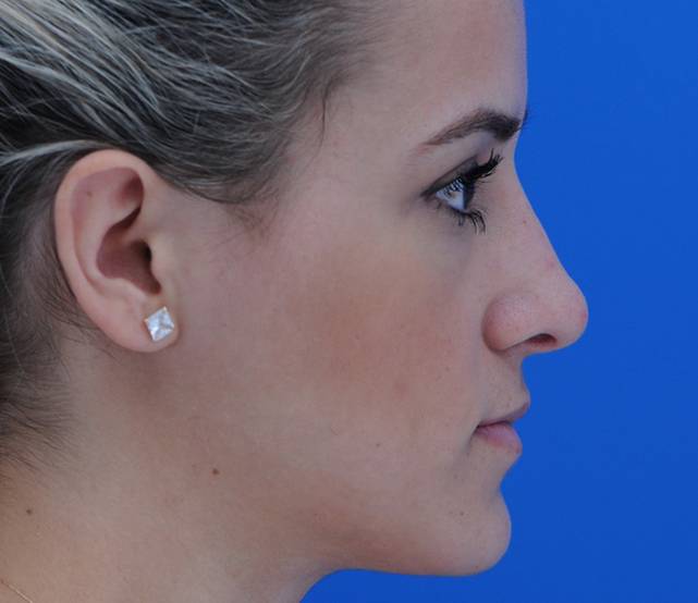 Rhinoplasty before and after - after
